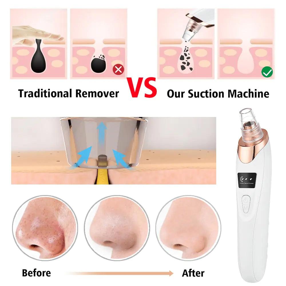 Vacuum Electric Blackhead Remover Cleaner - Emporium WRJJ