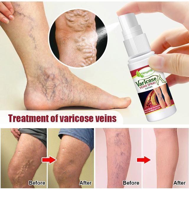 Varicose Veins Treatment Spray - Emporium WRJJ