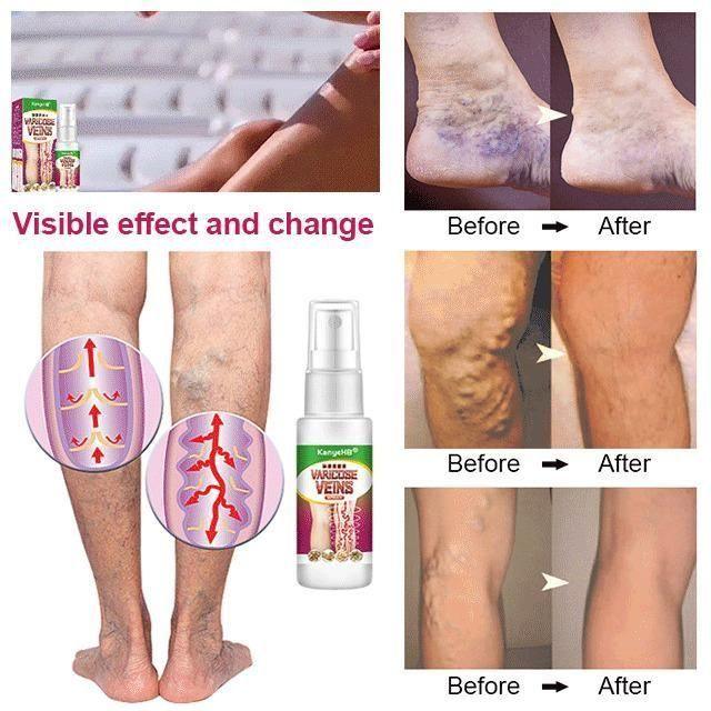 Varicose Veins Treatment Spray - Emporium WRJJ